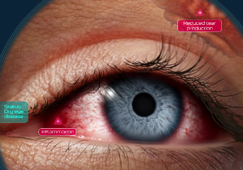 Dry Eye Disease & TL-925 MOA