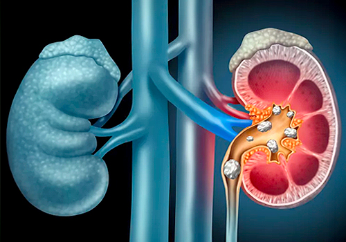 TITAN Health Awards Winner -  Sarcoidosis and kidney health By American Kidney Fund
