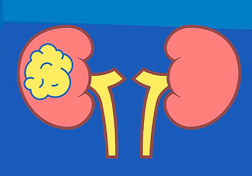 What is Kidney Cancer?, Healthcare Awards Winner