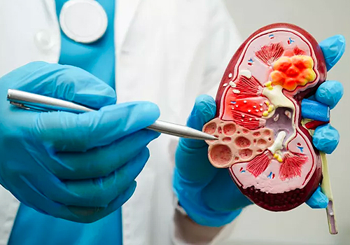 BK virus after kidney transplant, Healthcare Awards Winner